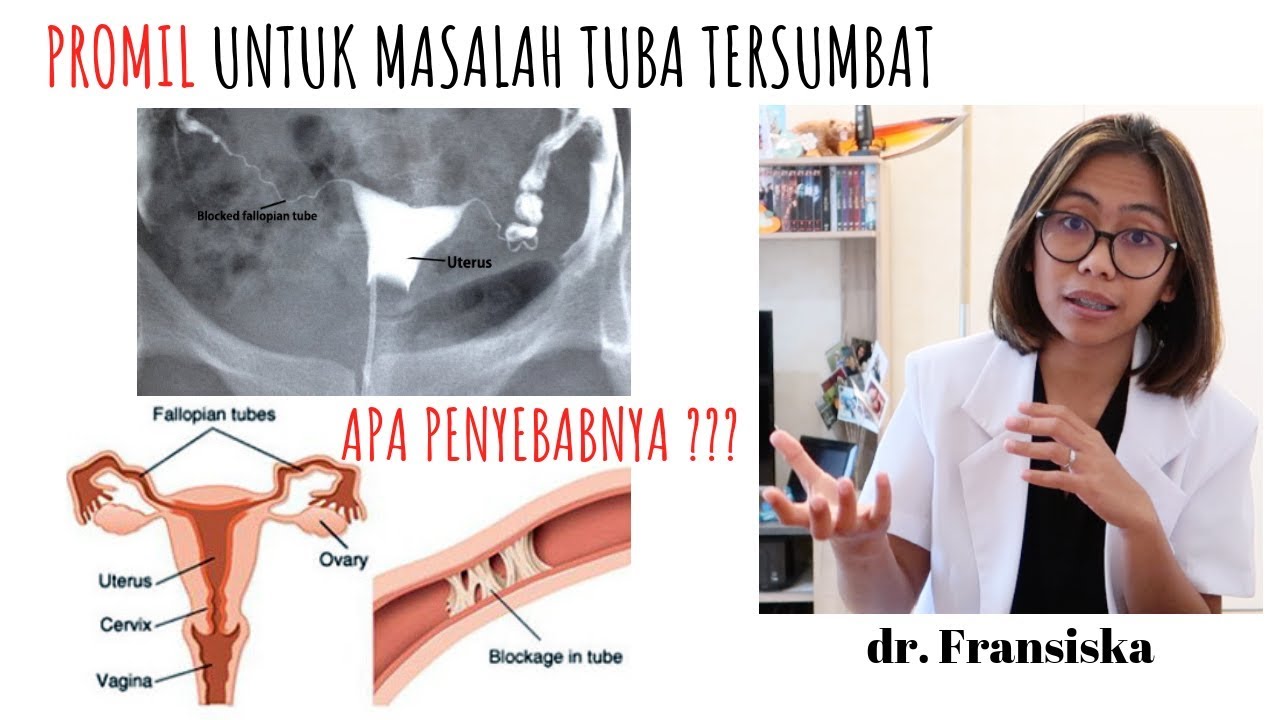 Detail Gambar Tuba Fallopi Nomer 48