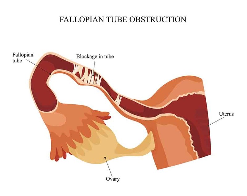 Detail Gambar Tuba Falopi Nomer 8