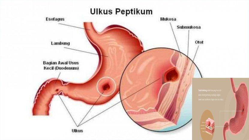 Detail Gambar Tukak Lambung Nomer 16