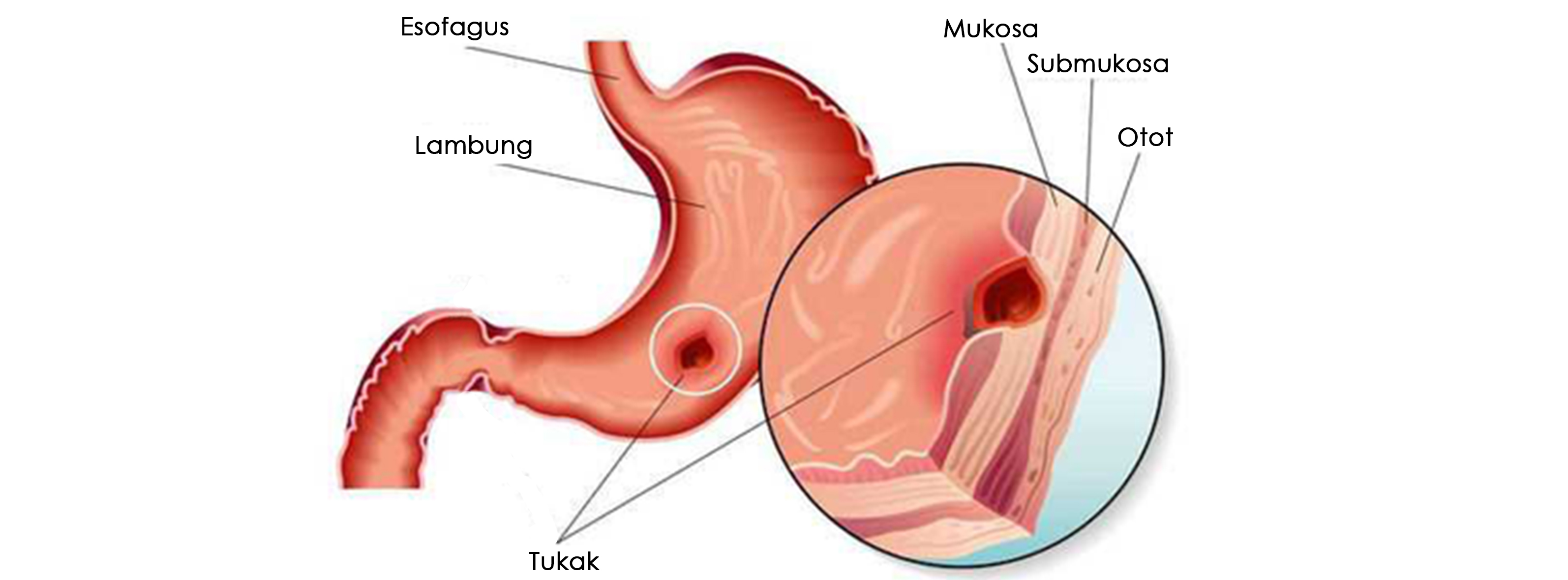 Detail Gambar Tukak Lambung Nomer 17