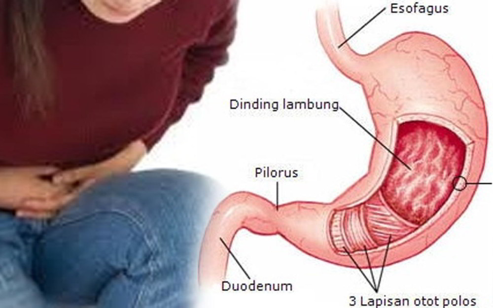 Detail Gambar Tukak Lambung Nomer 42