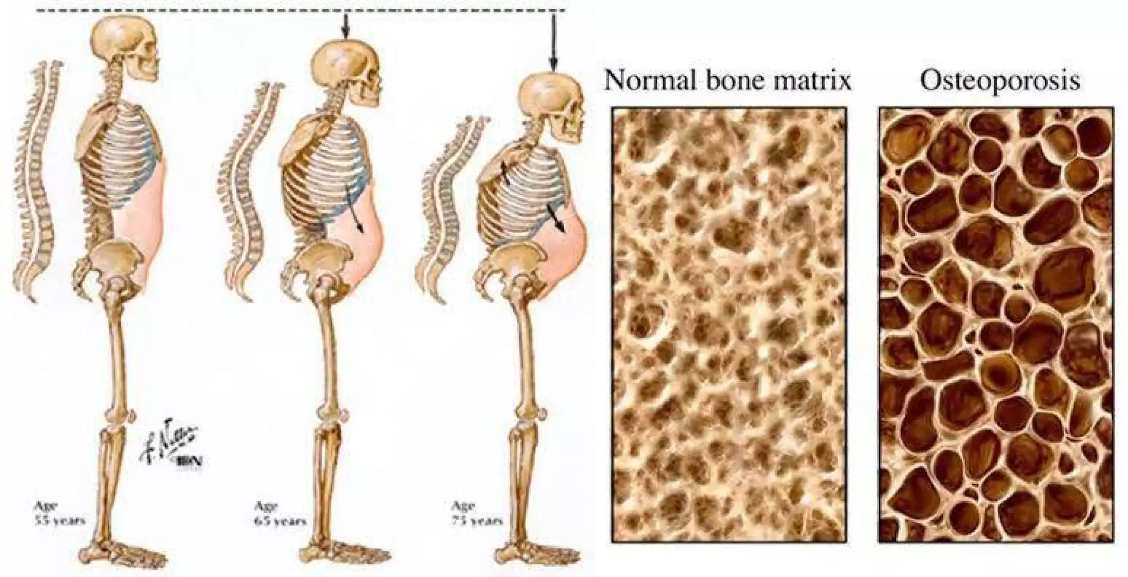 Detail Gambar Tulang Keropos Nomer 13