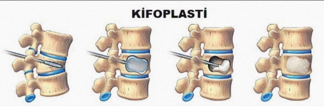 Detail Gambar Tulang Keropos Nomer 44