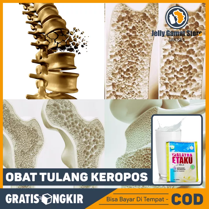 Detail Gambar Tulang Keropos Nomer 46