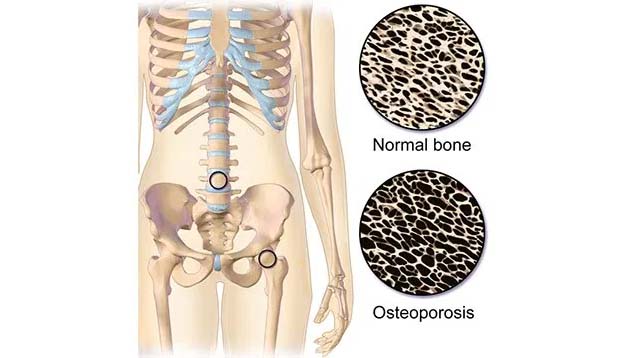 Detail Gambar Tulang Keropos Nomer 53