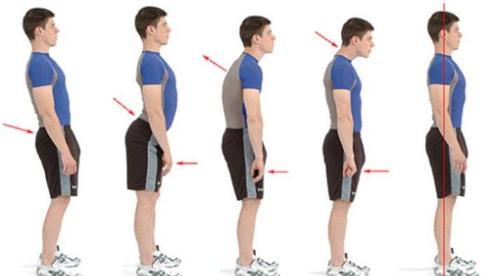 Detail Gambar Tulang Lordosis Nomer 13