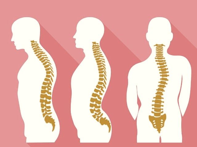 Detail Gambar Tulang Lordosis Nomer 5