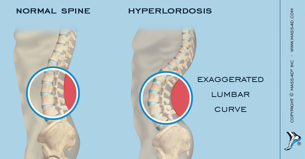 Detail Gambar Tulang Lordosis Nomer 40