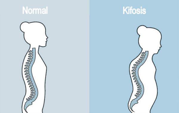 Detail Gambar Tulang Lordosis Nomer 47