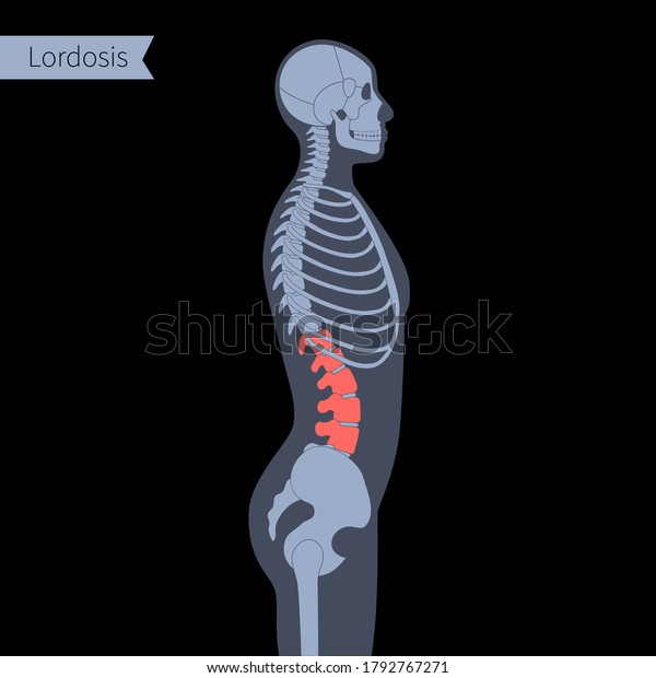 Detail Gambar Tulang Lordosis Nomer 52