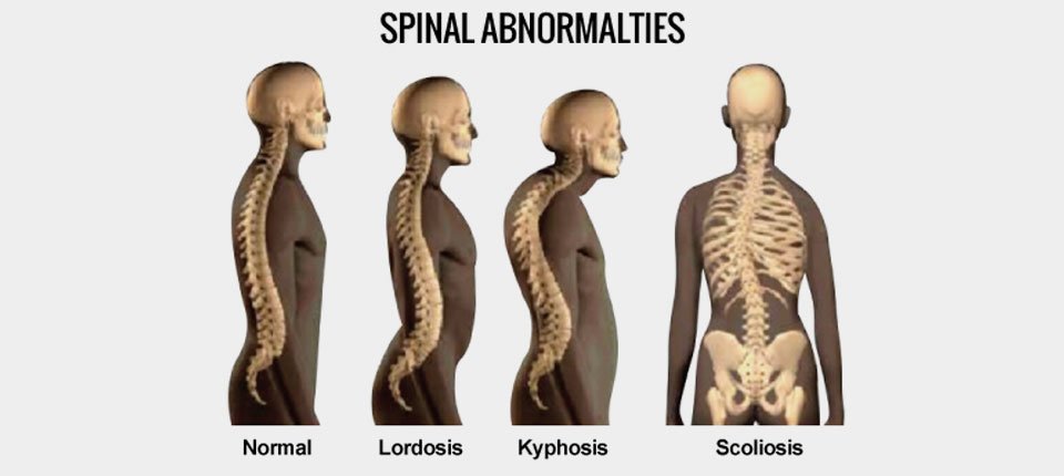 Detail Gambar Tulang Lordosis Nomer 7