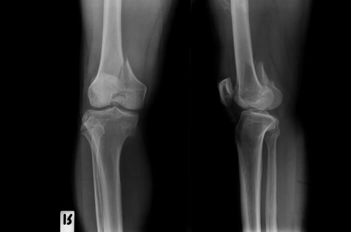 Detail Gambar Tulang Lutut Nomer 5