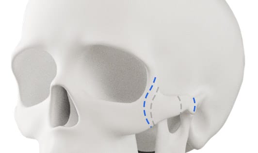 Gambar Tulang Pipi - KibrisPDR