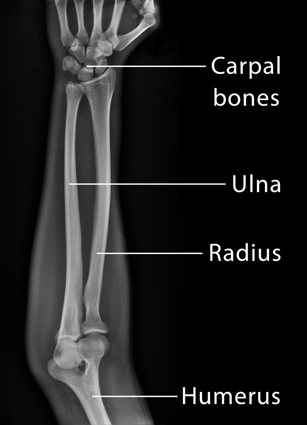 Detail Gambar Tulang Radius Nomer 28