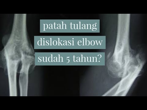 Detail Gambar Tulang Siku Tangan Kiri Nomer 26