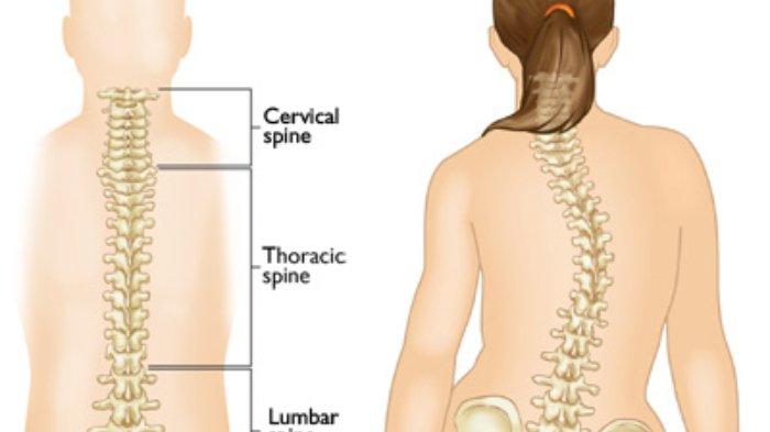 Detail Gambar Tulang Skoliosis Nomer 17