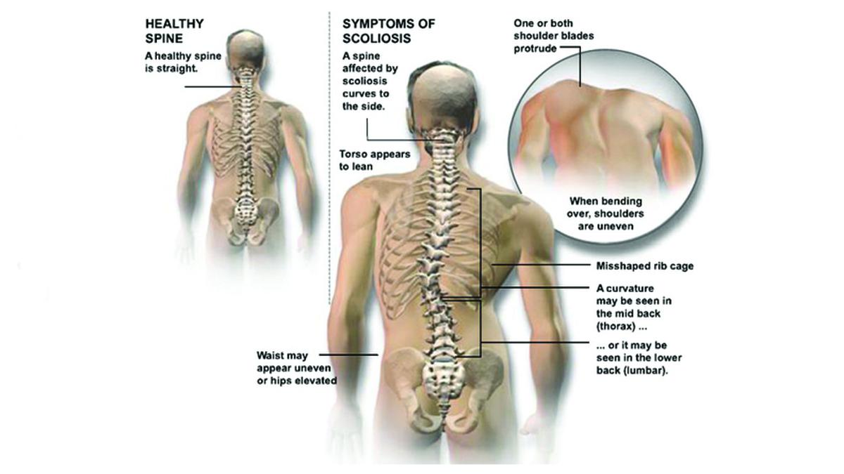 Detail Gambar Tulang Skoliosis Nomer 22