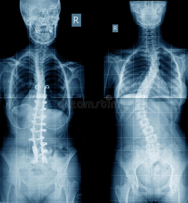 Detail Gambar Tulang Skoliosis Nomer 25