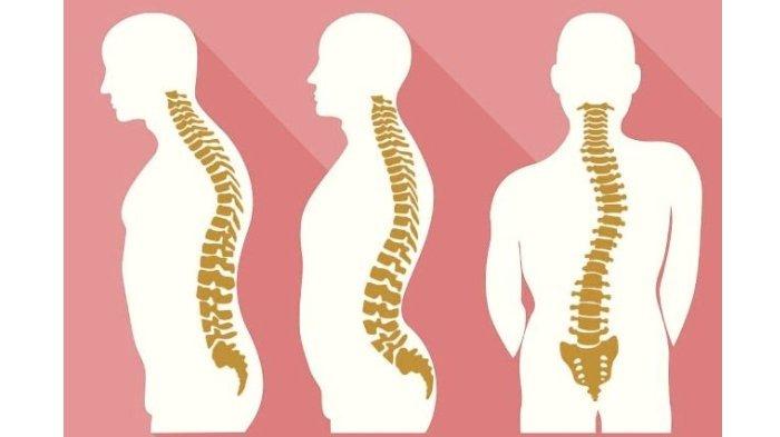 Detail Gambar Tulang Skoliosis Nomer 26