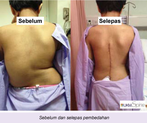 Detail Gambar Tulang Skoliosis Nomer 38