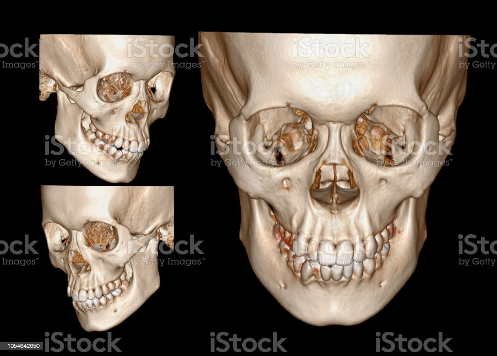 Detail Gambar Tulang Wajah Nomer 20