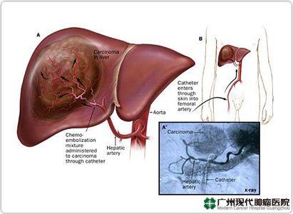 Detail Gambar Tumor Hati Nomer 13