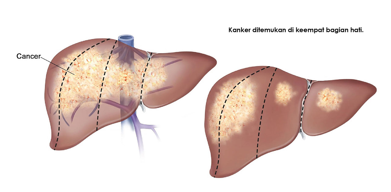 Detail Gambar Tumor Hati Nomer 36