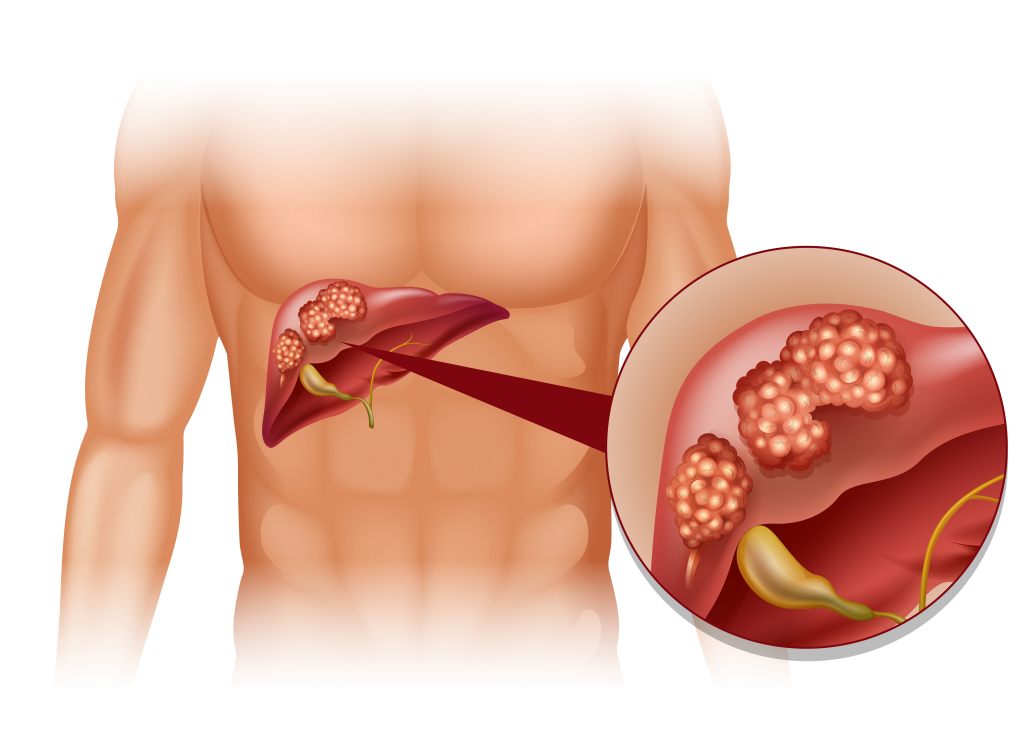 Detail Gambar Tumor Hati Nomer 6