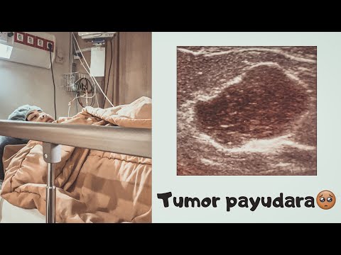 Detail Gambar Tumor Mamae Nomer 16