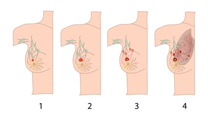 Detail Gambar Tumor Mamae Nomer 31