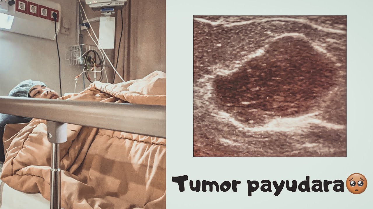 Detail Gambar Tumor Mamae Nomer 5