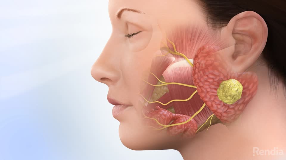 Gambar Tumor Parotis - KibrisPDR