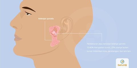 Detail Gambar Tumor Parotis Nomer 2