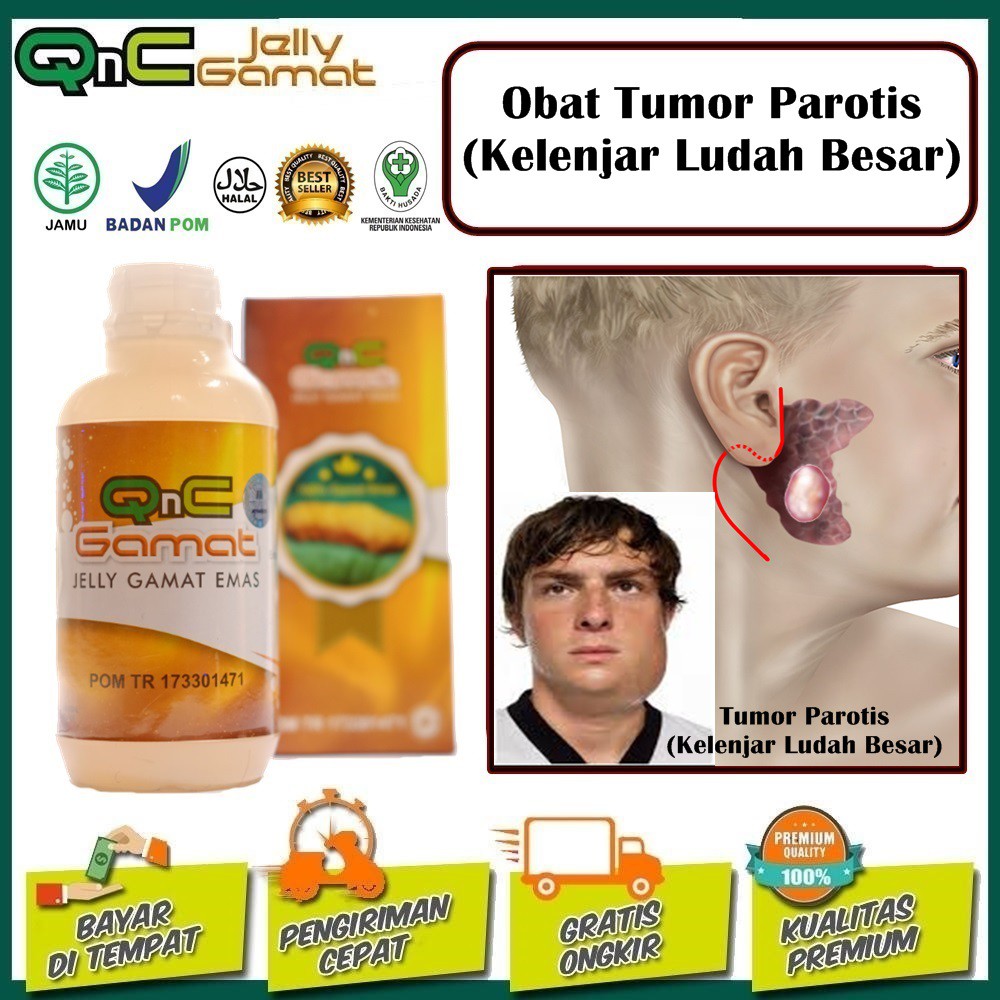 Detail Gambar Tumor Parotis Nomer 43