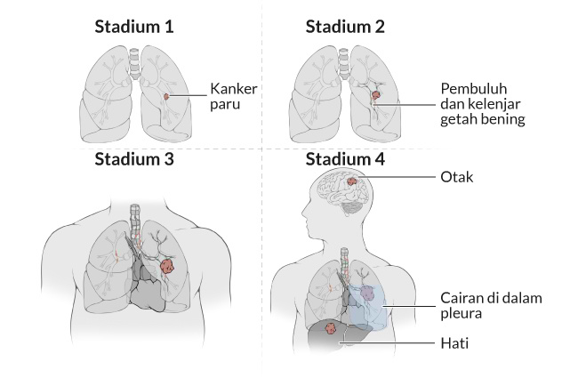 Detail Gambar Tumor Paru Paru Nomer 7