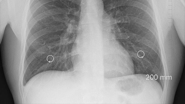 Detail Gambar Tumor Paru Paru Nomer 8