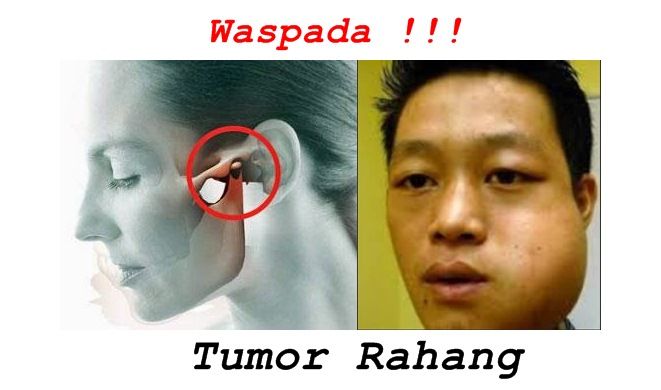 Detail Gambar Tumor Rahang Nomer 22