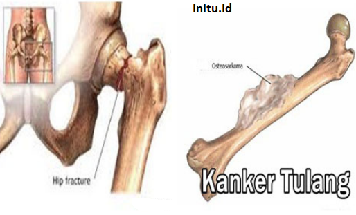 Detail Gambar Tumor Tulang Nomer 27