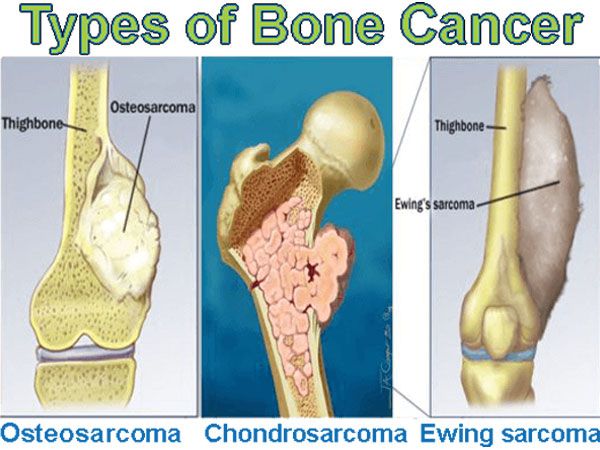 Detail Gambar Tumor Tulang Nomer 32