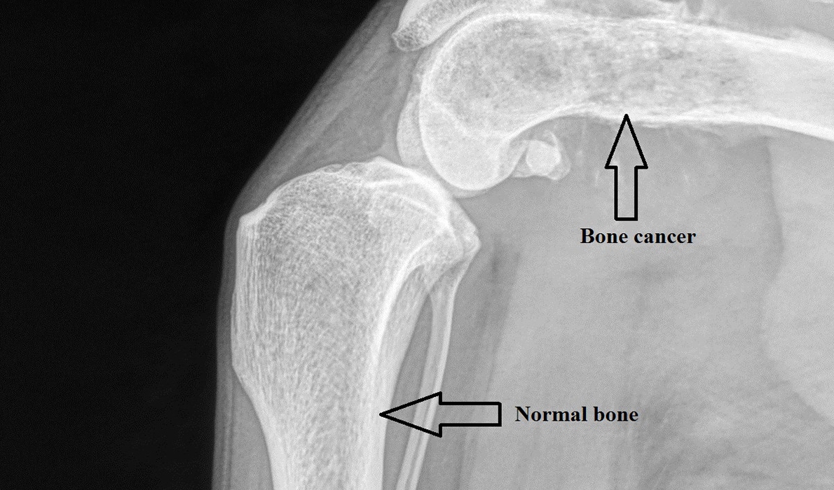 Detail Gambar Tumor Tulang Nomer 38