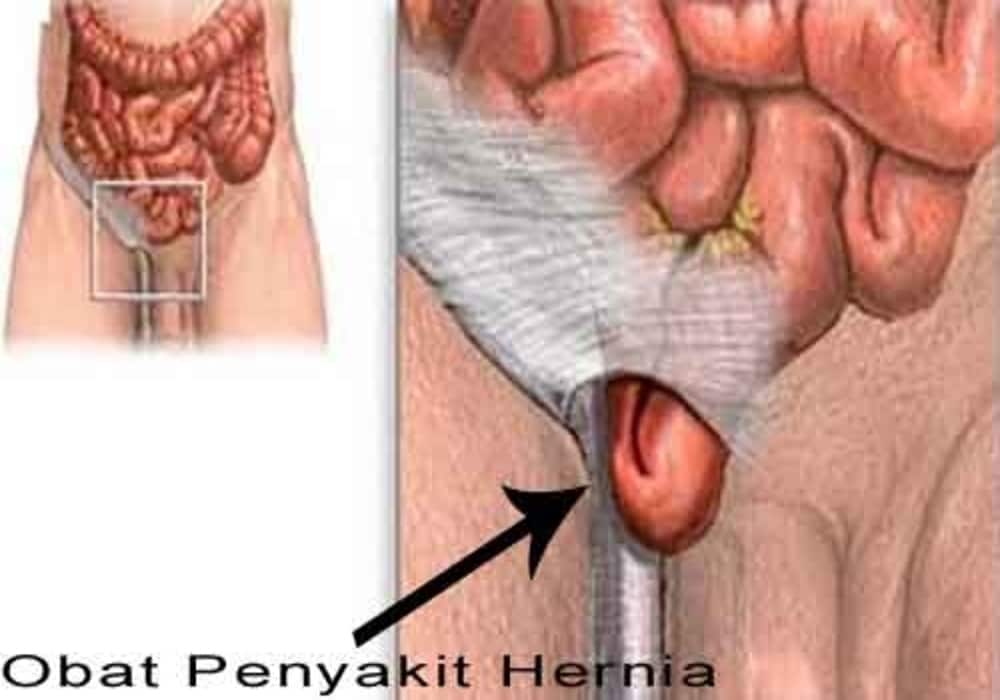 Detail Gambar Turun Berok Laki Laki Nomer 11