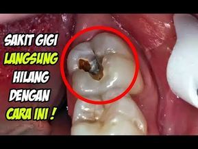 Detail Gambar Ulat Gigi Nomer 45