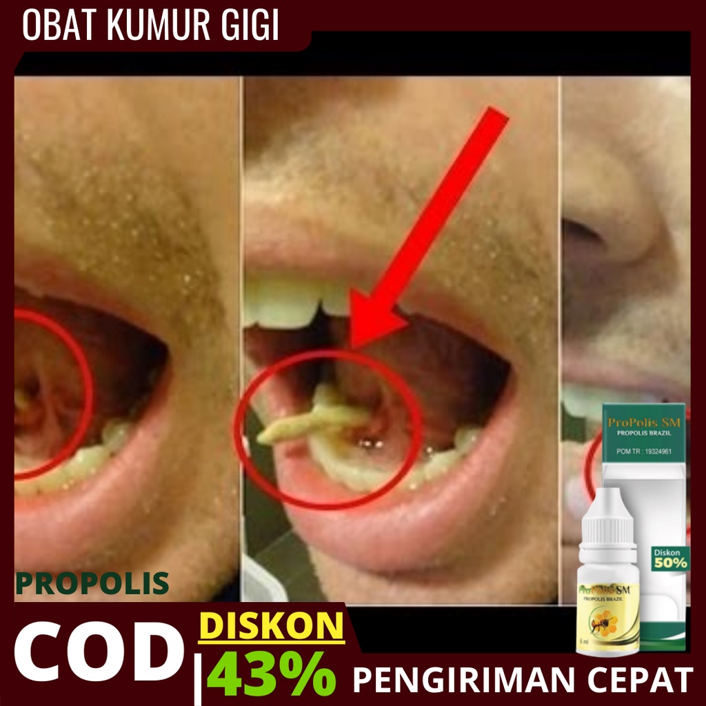 Detail Gambar Ulat Gigi Berlubang Nomer 9