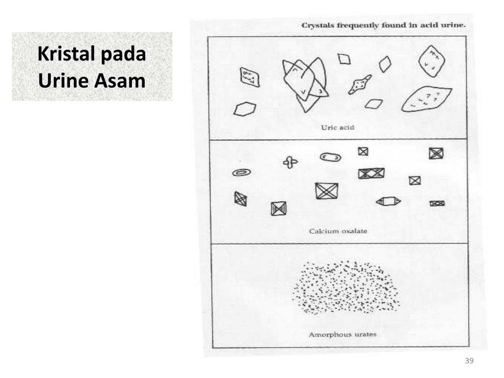 Detail Gambar Uric Acid Dalam Sedimen Urin Nomer 13