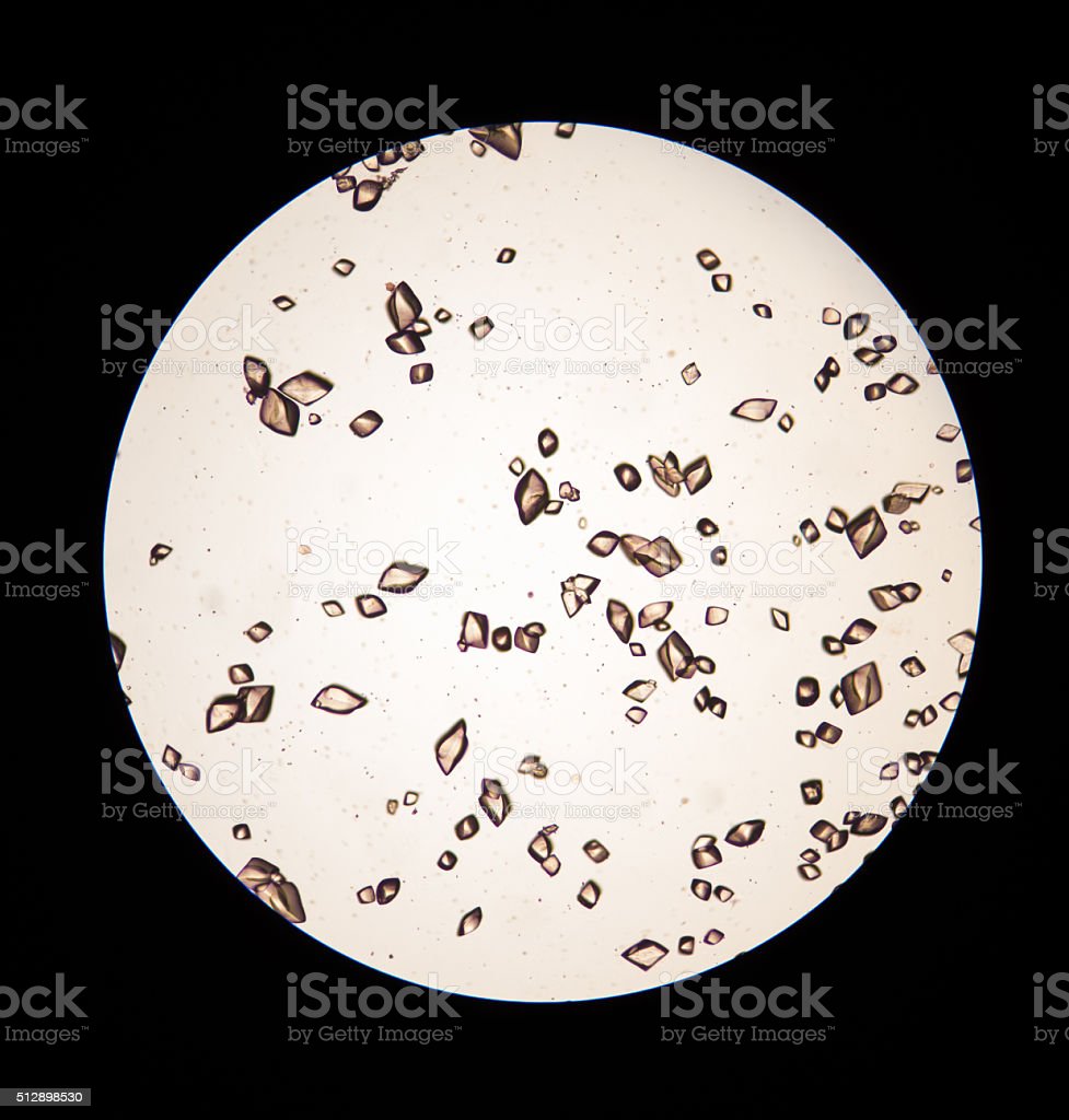 Detail Gambar Uric Acid Dalam Sedimen Urin Nomer 3