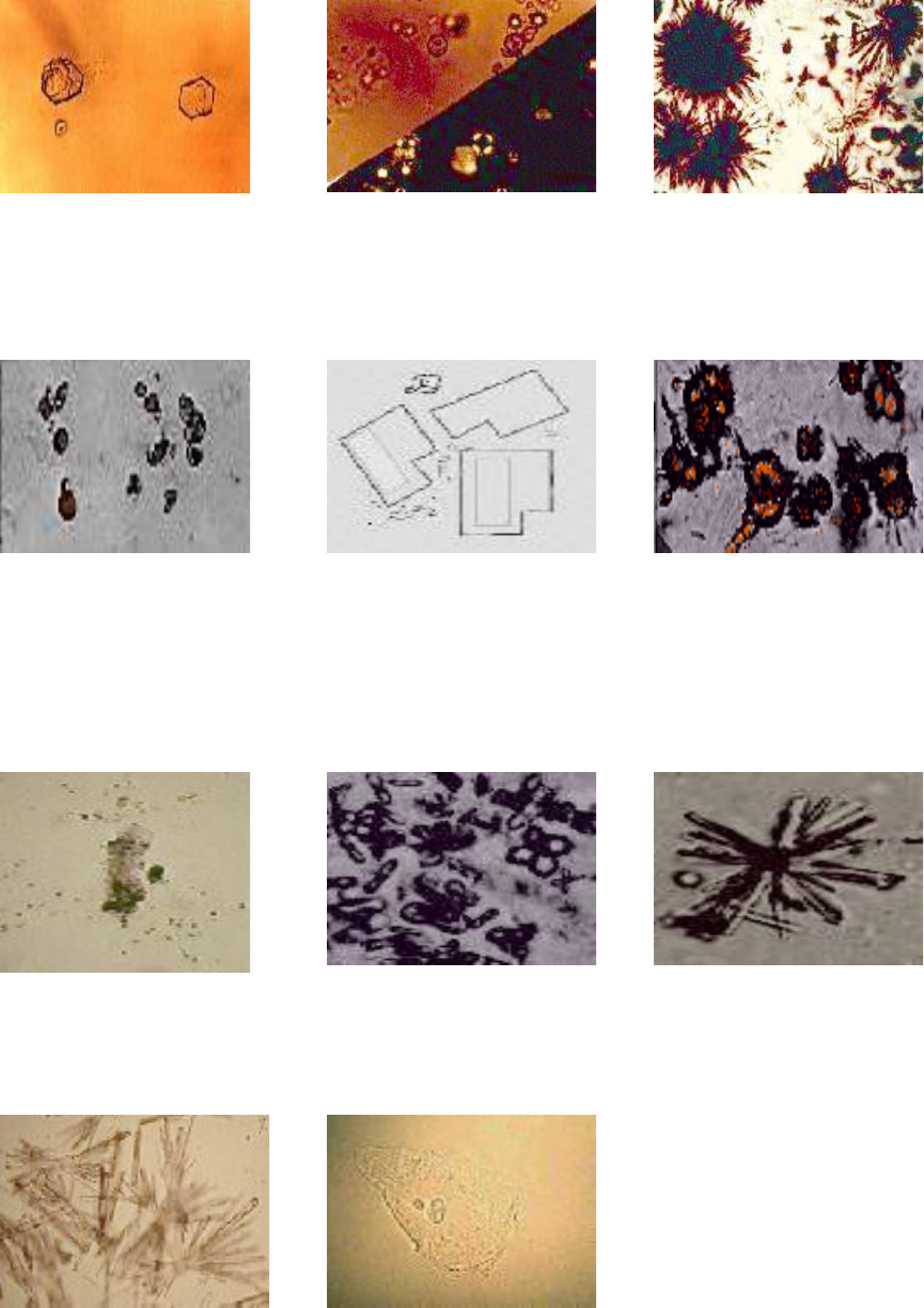 Detail Gambar Uric Acid Dalam Sedimen Urin Nomer 19