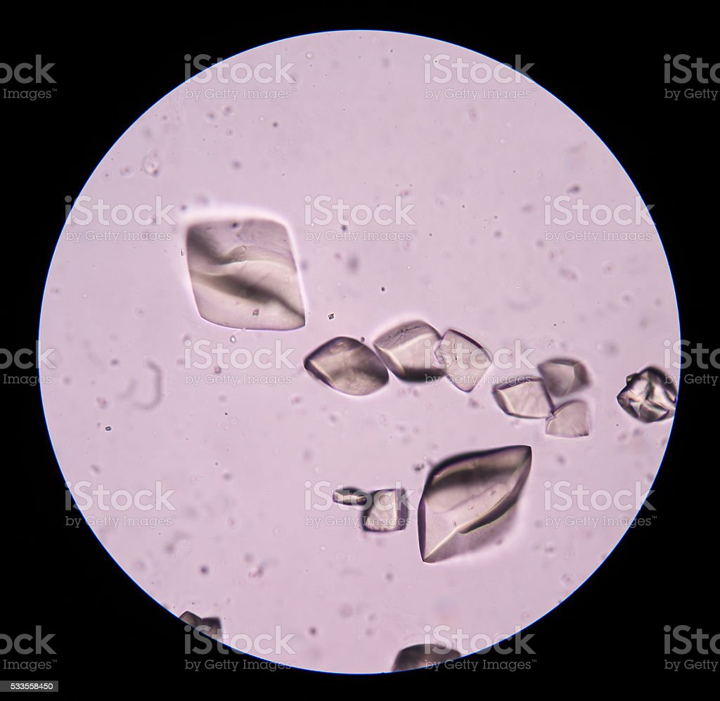Detail Gambar Uric Acid Dalam Sedimen Urin Nomer 4