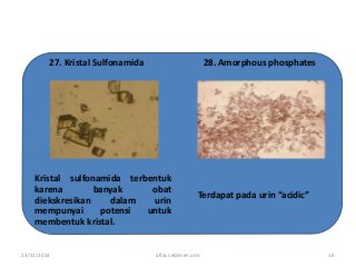 Detail Gambar Uric Acid Dalam Sedimen Urin Nomer 27