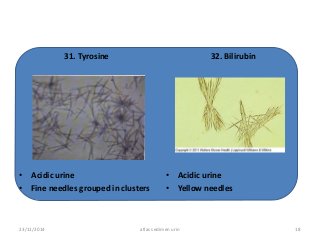 Detail Gambar Uric Acid Dalam Sedimen Urin Nomer 31