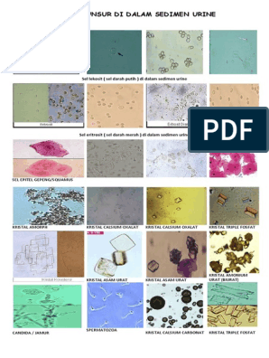 Detail Gambar Uric Acid Dalam Sedimen Urin Nomer 7